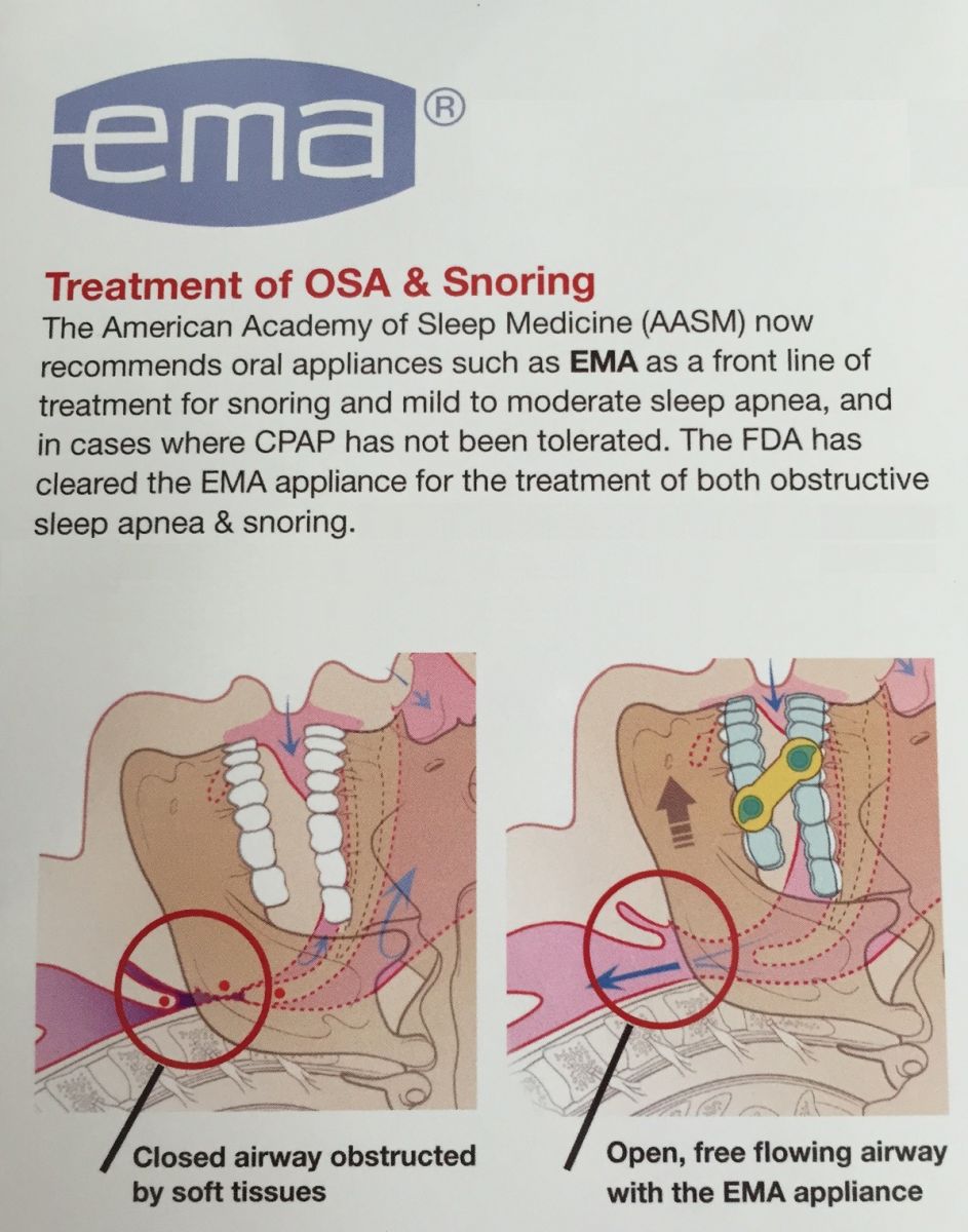EMA Appliance to Treat OSA and Snoring
